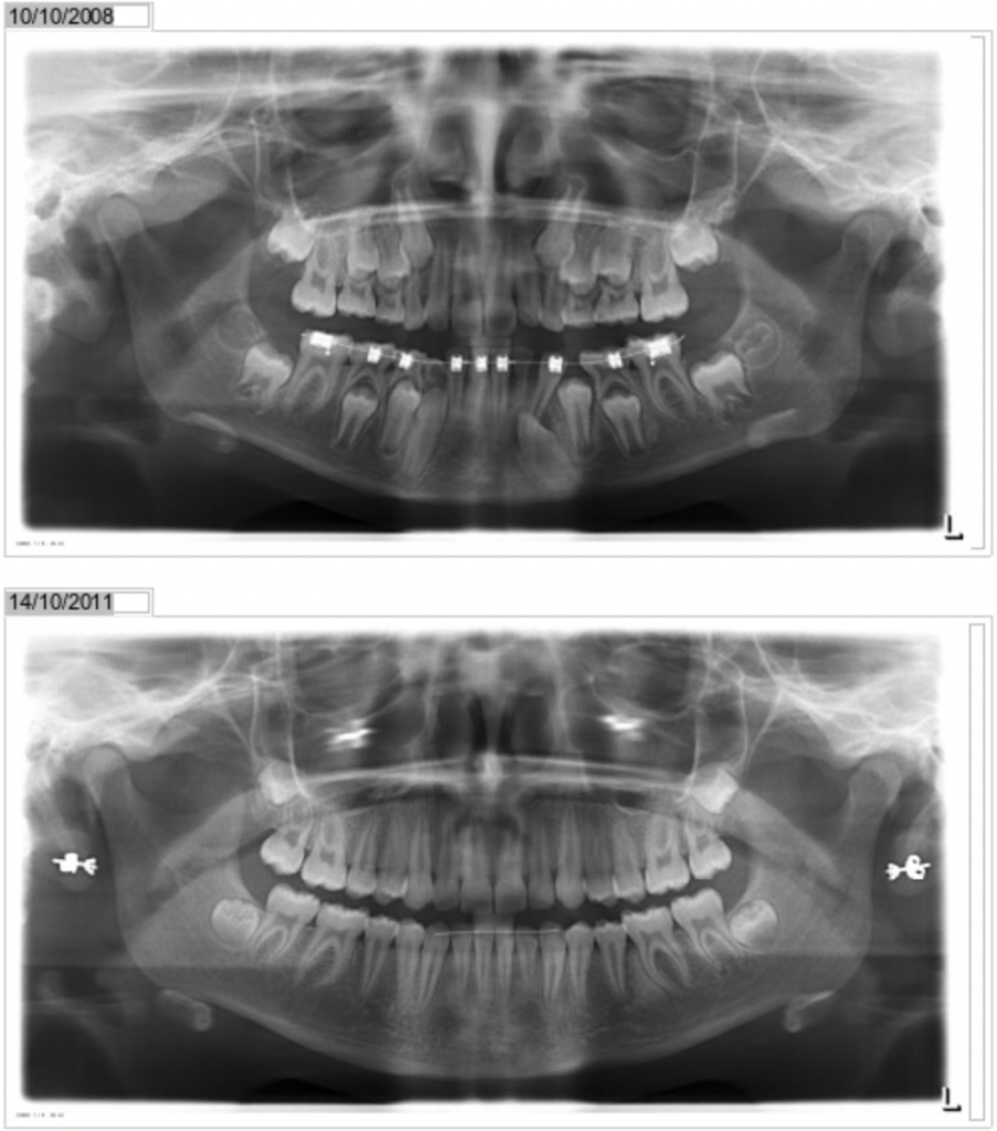 dentaltransposition