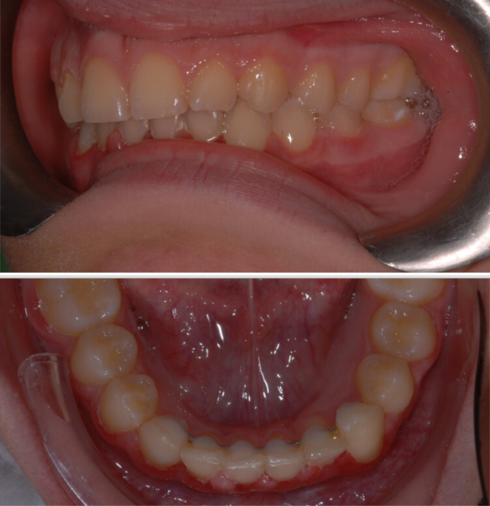 dental transposition