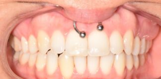 Smiley Piercing: Il Dolore Dopo l’Intervento smiley piercing
